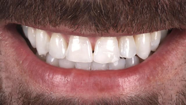 Composite Bonding before