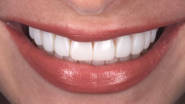 Composite Bonding after
