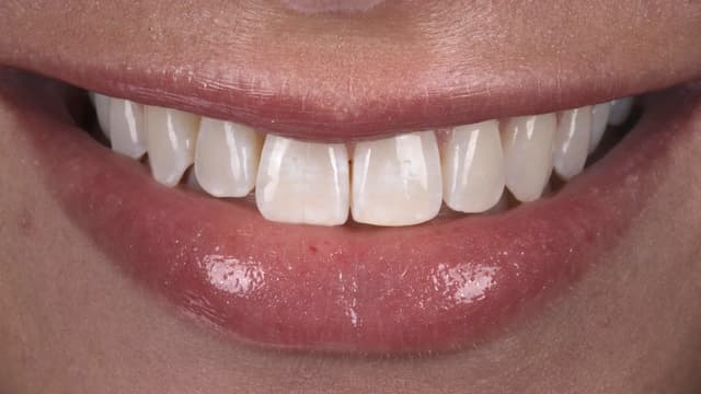 Composite Bonding before