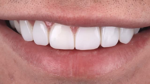 Composite Bonding after