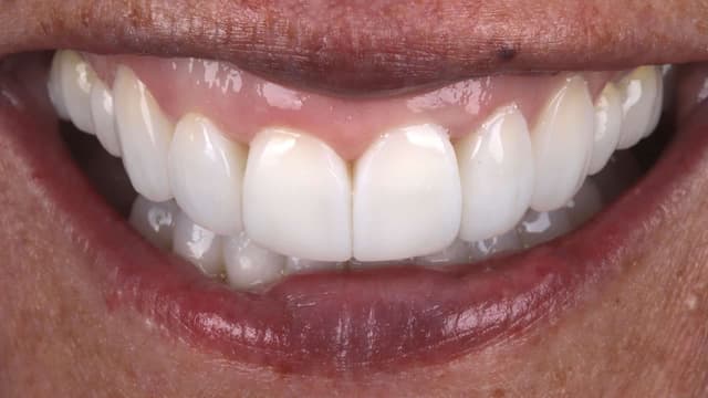 Composite Bonding after