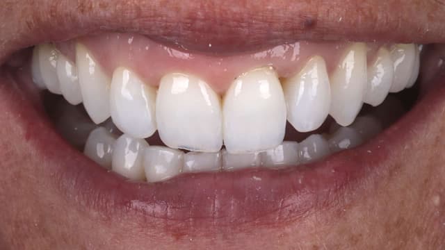 Composite Bonding before
