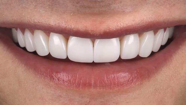 Composite Bonding after