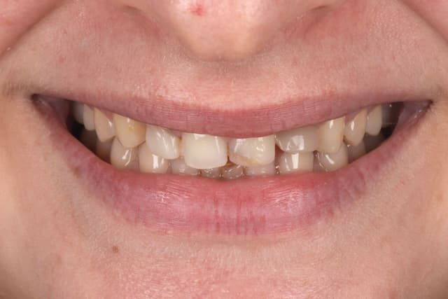 Porcelain Veneers before