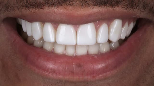 Composite Bonding after