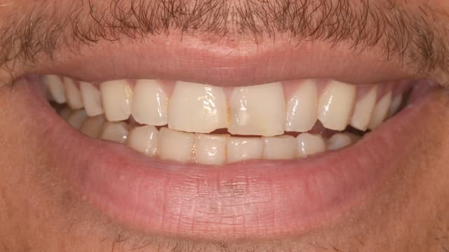 Composite Bonding before