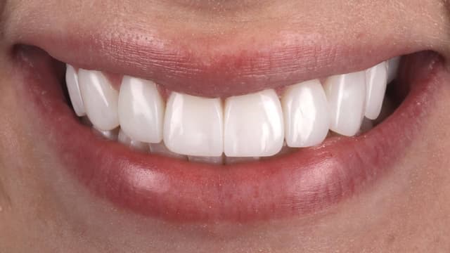 Composite Bonding after