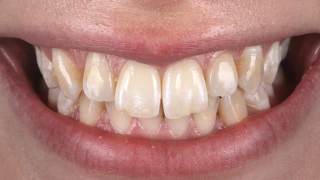 Composite Bonding before
