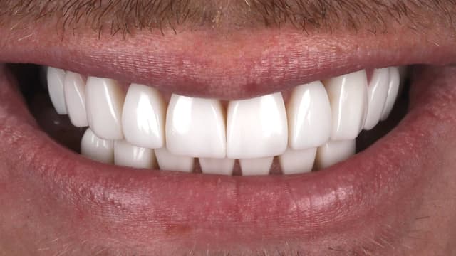 Composite Bonding after