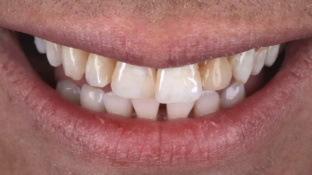 Composite Bonding before
