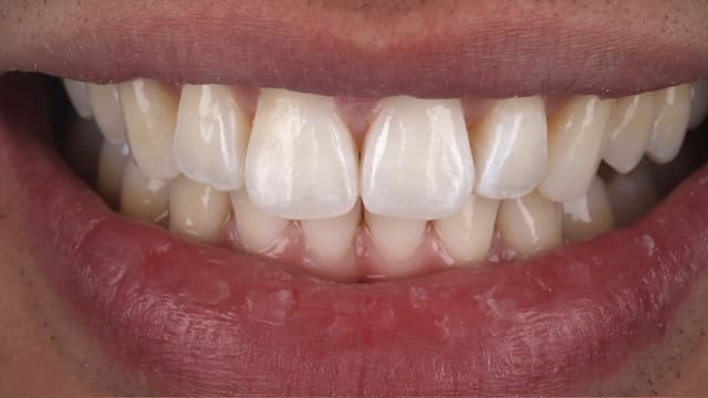 Clear Aligners after