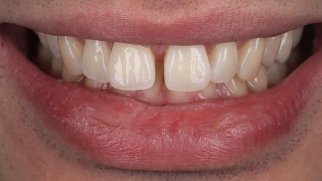 Clear Aligners before