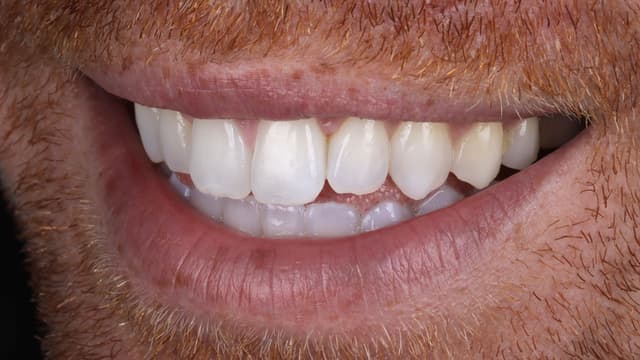 Clear Aligners after