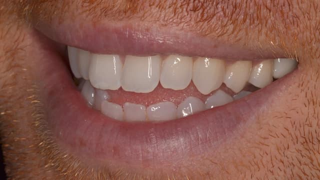 Clear Aligners before
