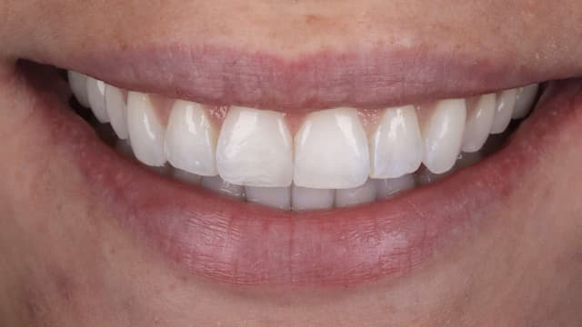 Clear Aligners after