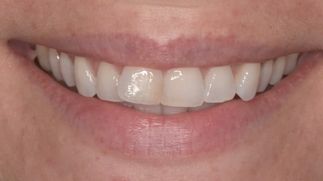 Clear Aligners before