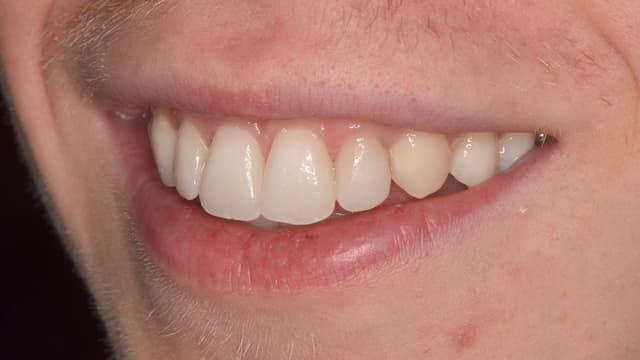 Clear Aligners after