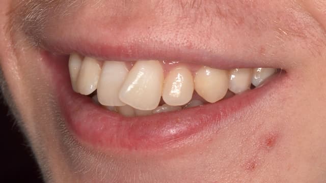 Clear Aligners before