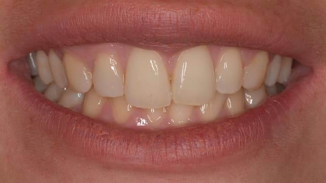 ABC Smile Makeover before