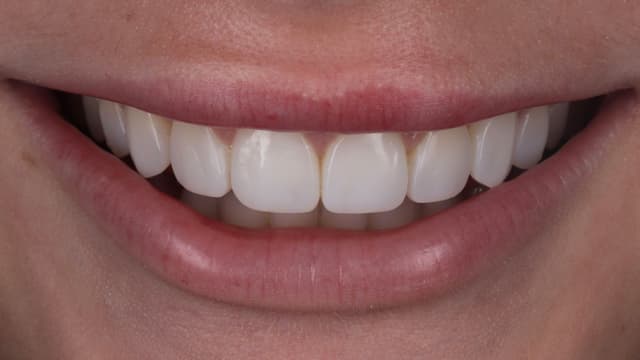ABC Smile Makeover after