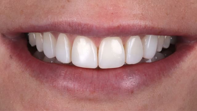 ABC Smile Makeover after