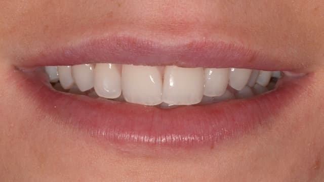 ABC Smile Makeover before