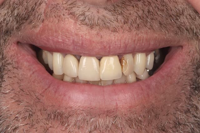 Porcelain Veneers before