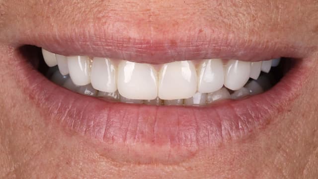 ABC Smile Makeover after