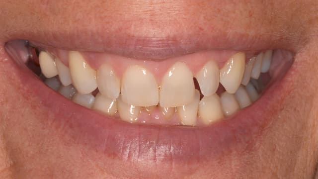 ABC Smile Makeover before