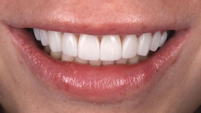 ABC Smile Makeover after