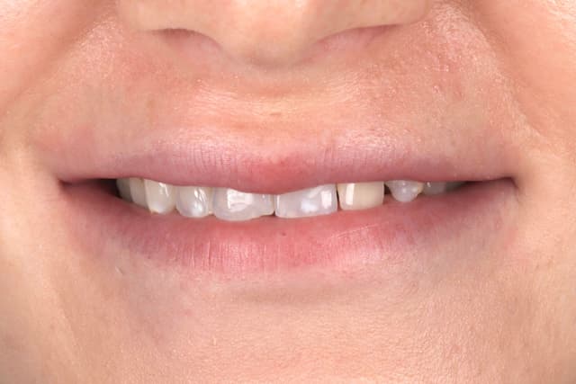 Porcelain Veneers before