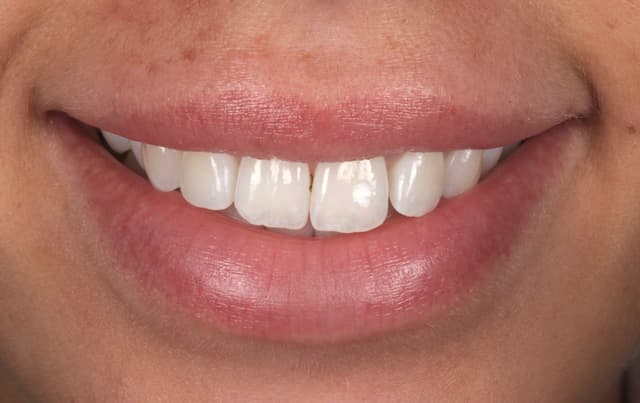 Composite Bonding before