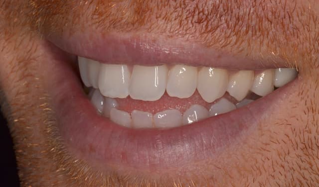 Clear Aligners before